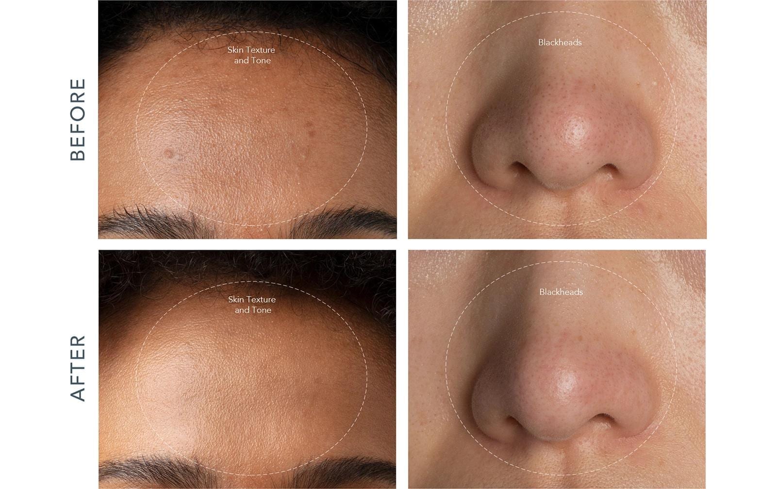 FOREO Nettoyant pour pores »KIWI Vakuum mit Blaulichttherapie« Extracteur de points noirs à vide avec technologie lumière bleue