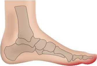 Fussgut Überbeinschutz »Hallux Schutz mit Gelpolster«, Druckentlastung bei Hallux Valgus, Hallux Valgus Bandage