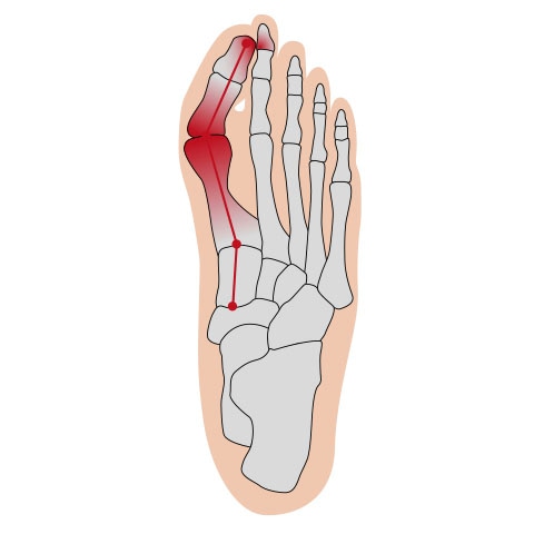 Fussgut Hallux-Bandage »Softkissen mit Fixierband, verhindert Reiben«, Druckentlastung bei Hühneraugen, Schwielen, Entlastung Hallux Valgus