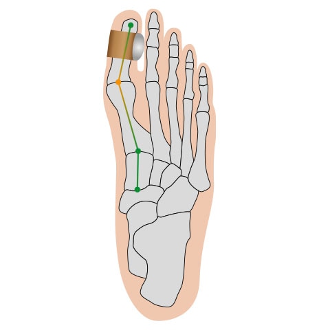 Fussgut Hallux-Bandage »Softkissen mit Fixierband, verhindert Reiben«, Druckentlastung bei Hühneraugen, Schwielen, Entlastung Hallux Valgus