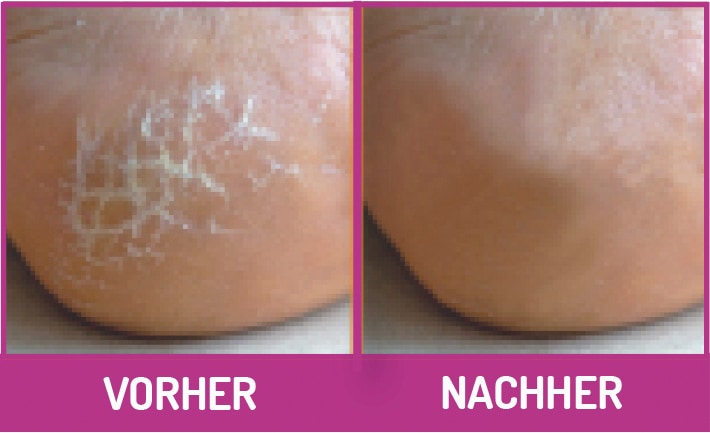 Fussgut Hornhautbalsam »Hornhaut-Reduzier-Balsam, für Diabetiker geeignet, pflegt Ellenbogen«, bis zu 75% Hornhautreduzierung innerhalb von 28 Tagen
